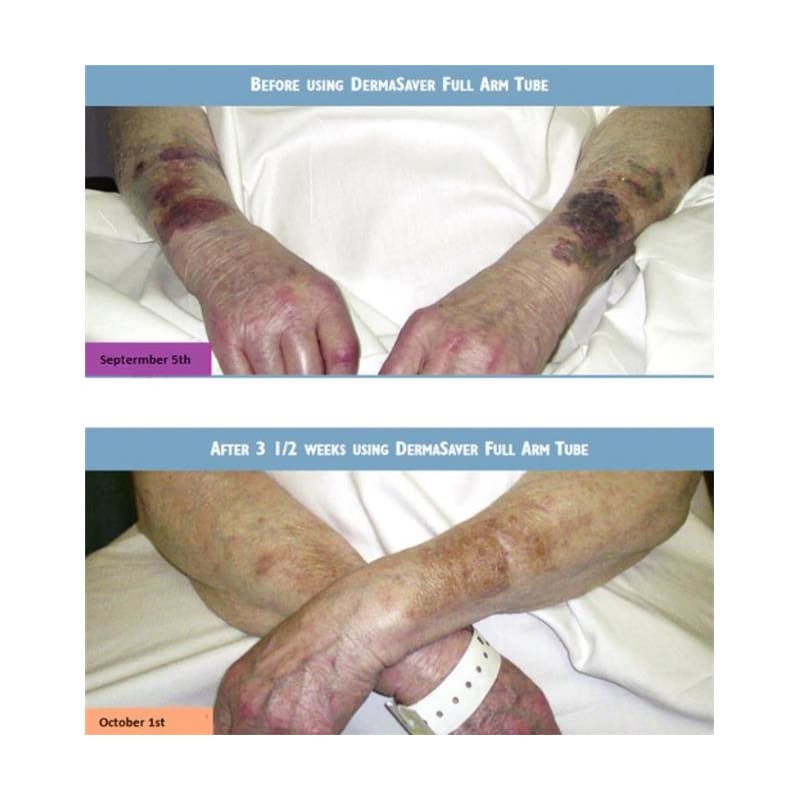 Hipsaver Dermasaver Arm Tubes Xs - Item Detail - Hipsaver