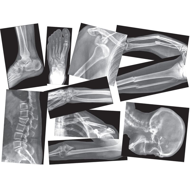 Broken Bones X-Rays - Human Anatomy - Roylco Inc.