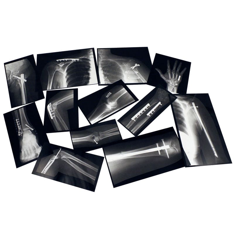 Fixed Bones X-Rays - Human Anatomy - Roylco Inc.