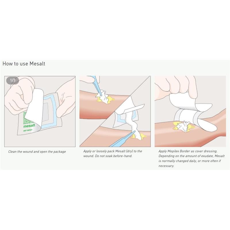 Mesalt Ribbon. Use Molnlycke Mesalt Ribbon 3/4